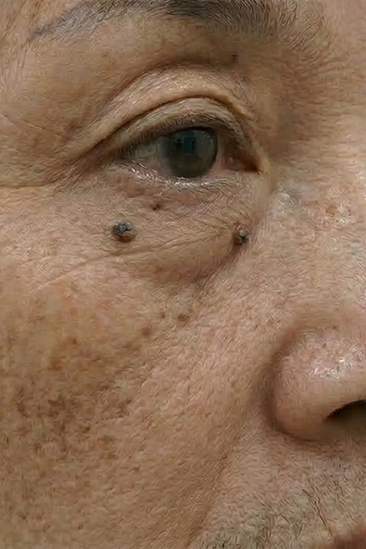 듀얼토닝 10회
+ 사마귀제거 1회 before